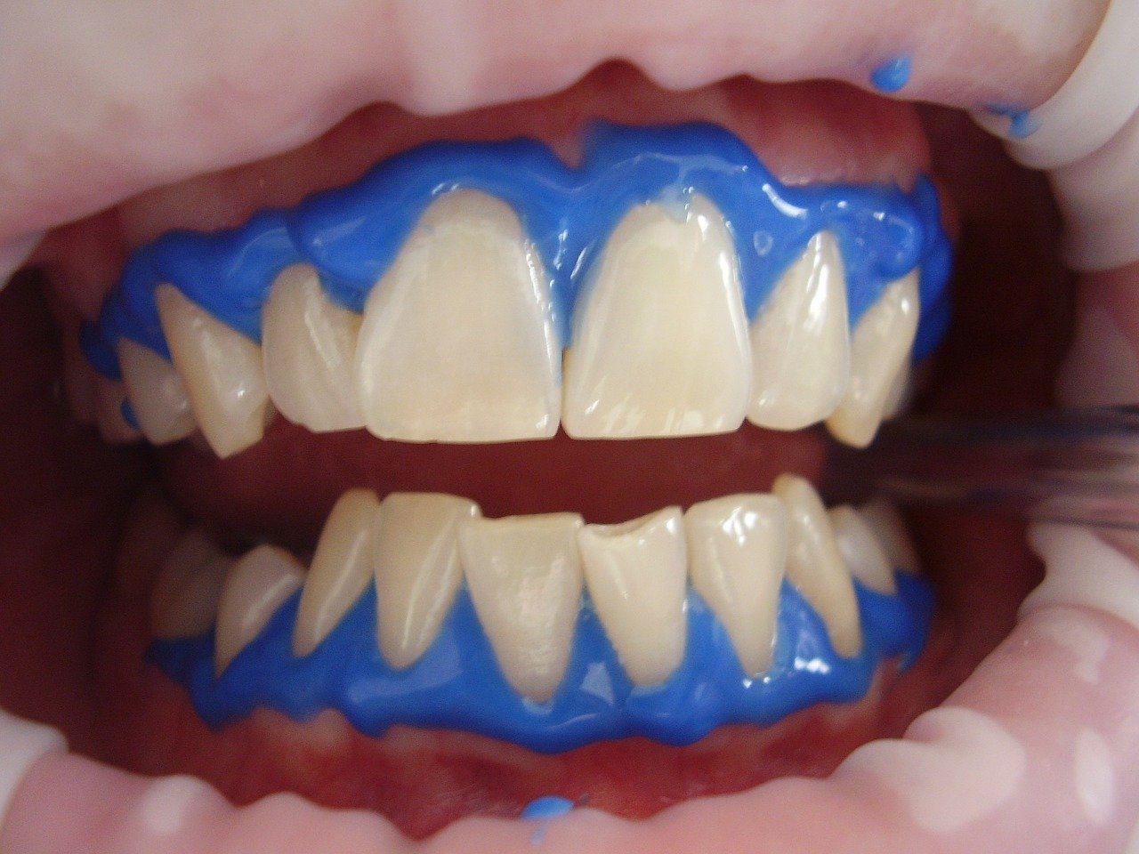 r90-laser-teeth-whitening-7164681280-15973216832433.jpg